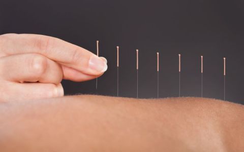 Image for 1. Acupuncture